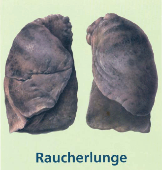 Lungenkrebs durch rauchen!!!