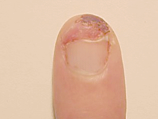Nail_growth